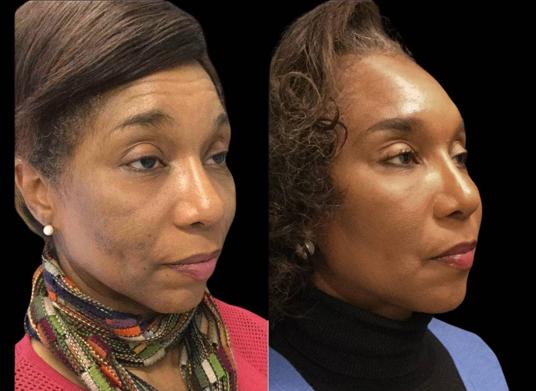 51-year-old-female-non-surgical-facelift-before-and-after-1.jpg