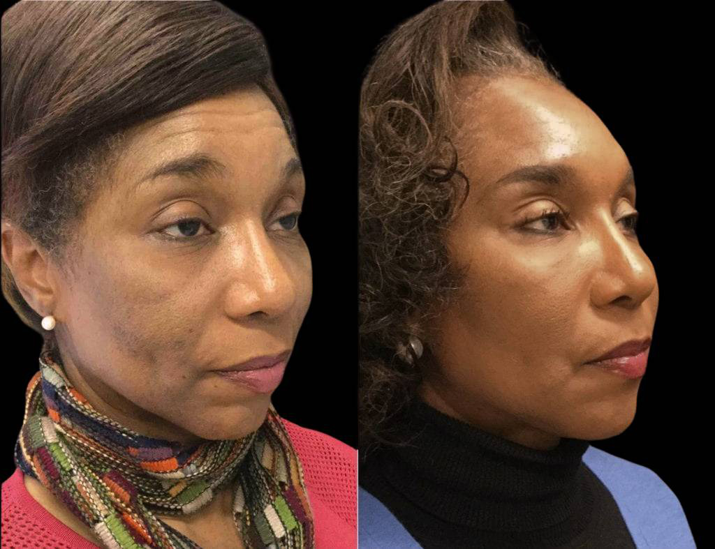 51-year-old-female-non-surgical-facelift-before-and-after-1.jpg