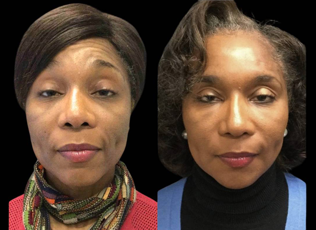 51-year-old-female-non-surgical-facelift-before-and-after.jpg