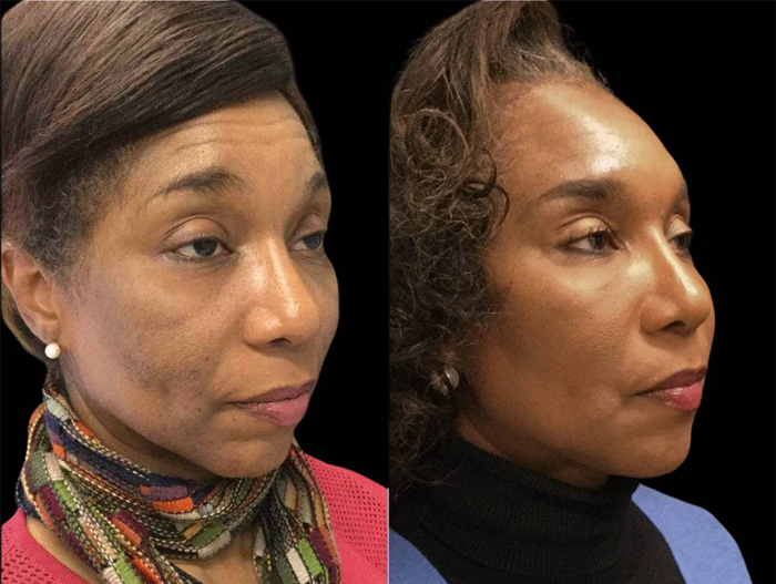 51-year-old-female-non-surgical-facelift-before-and-after-1.jpg