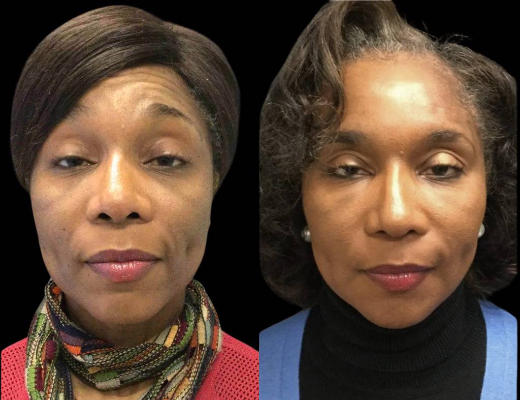 51-year-old-female-non-surgical-facelift-before-and-after.jpg