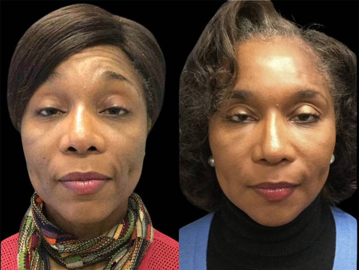51-year-old-female-non-surgical-facelift-before-and-after.jpg