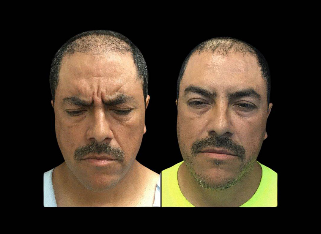 51-year-old-male-dysport-before-and-after.jpg