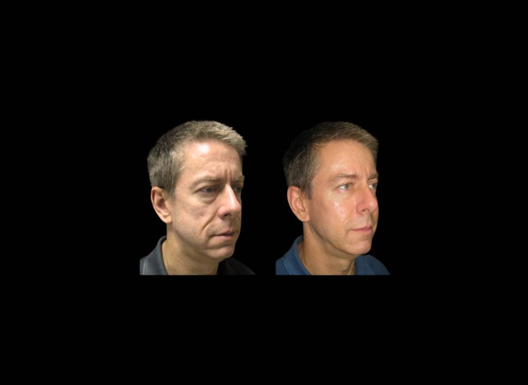 51-year-old-male-non-surgical-cheek-augmentation-before-and-after-1.jpg
