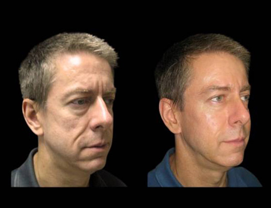 51-year-old-male-non-surgical-cheek-augmentation-before-and-after-1.jpg