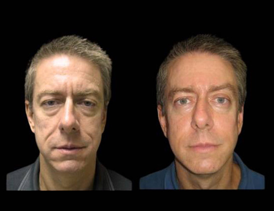 51-year-old-male-non-surgical-cheek-augmentation-before-and-after.jpg