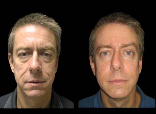 51-year-old-male-non-surgical-cheek-augmentation-before-and-after.jpg