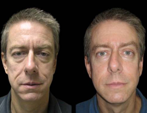 51-year-old-male-non-surgical-facelift-before-and-after-front-view.jpg