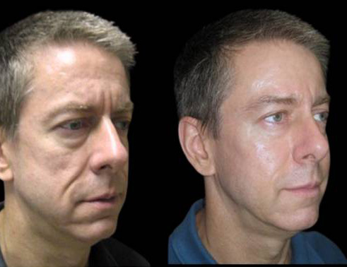 51-year-old-male-non-surgical-facelift-before-and-after-three-quarter-view.jpg