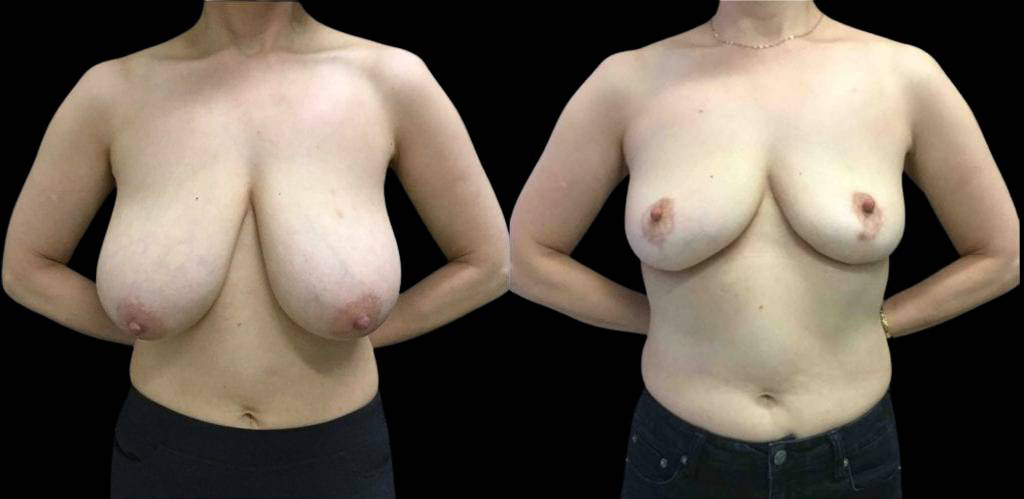 52-year-old-female-breast-reduction-before-and-after-front-view-21925.jpg