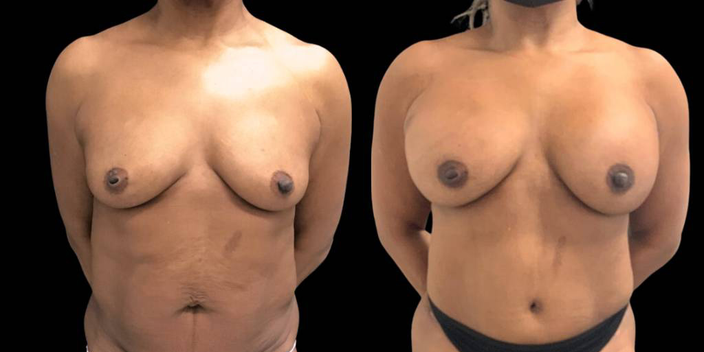 52-year-old-female-liposuction-before-and-after-front-view.jpg