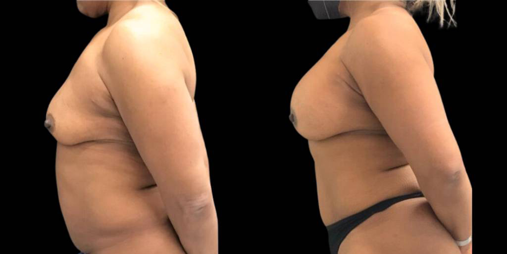 52-year-old-female-liposuction-before-and-after-side-view-2.jpg
