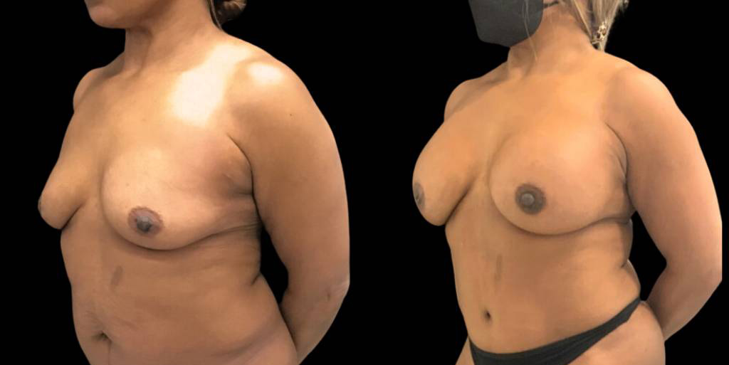 52-year-old-female-liposuction-before-and-after-three-quarter-view.jpg