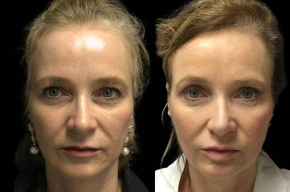 52-year-old-female-upper-and-lower-eyelid-lift-before-and-after-front-view-27295.jpg
