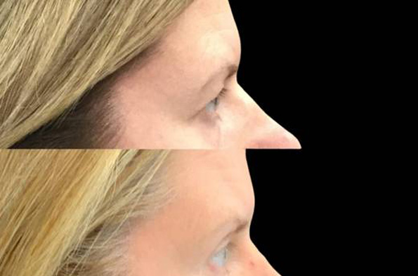 52-year-old-female-upper-and-lower-eyelid-lift-before-and-after-side-view-30848.jpg