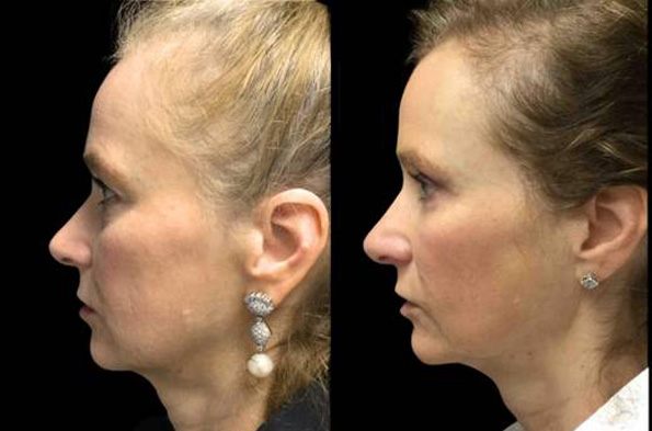 52-year-old-female-upper-and-lower-eyelid-lift-before-and-after-side-view.jpg