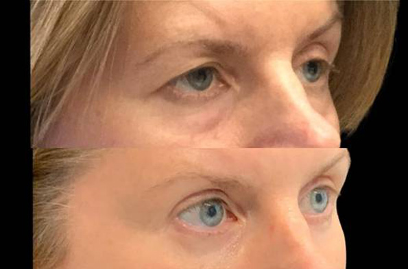 52-year-old-female-upper-and-lower-eyelid-lift-before-and-after-three-quarter-view.jpg