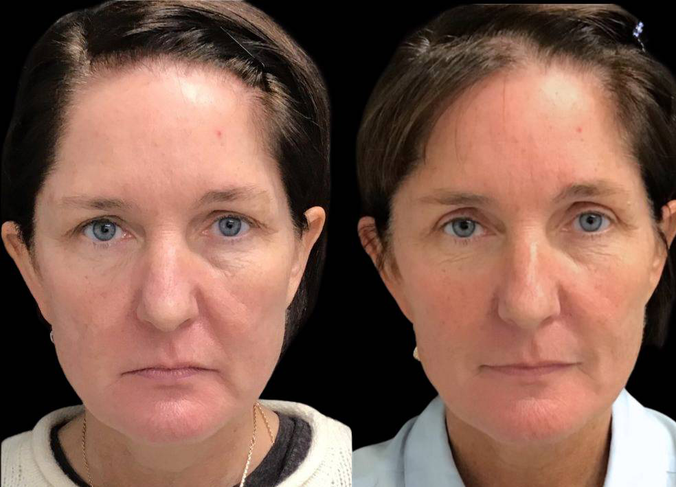 52-year-old-female-upper-eyelid-lift-before-and-after-front-view.jpg