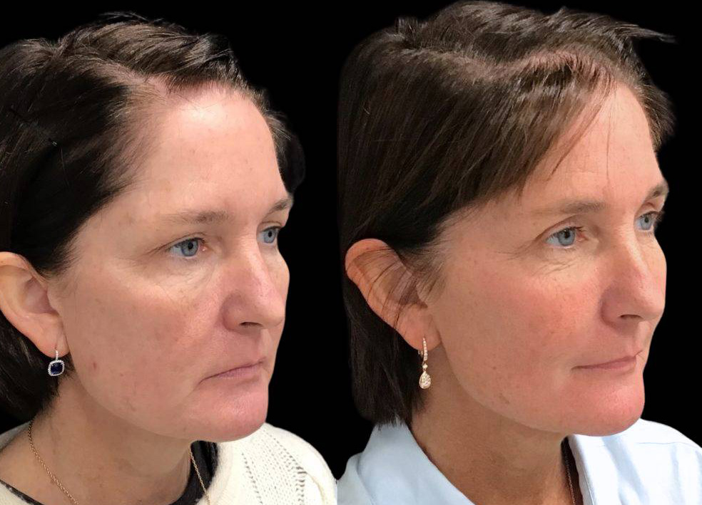 52-year-old-female-upper-eyelid-lift-before-and-after-three-quarter-view-34514.jpg