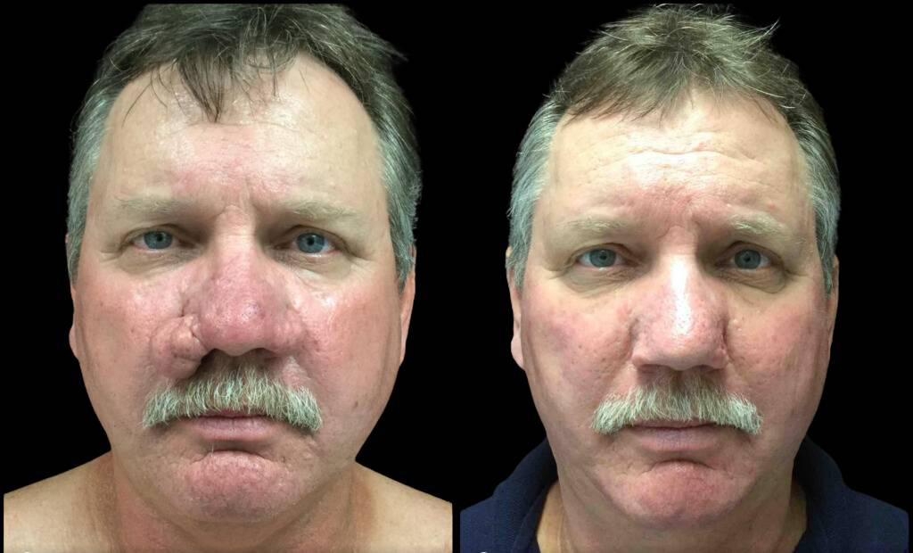 52-year-old-male-rhinophyma-reduction-before-and-after-front-view-.jpg
