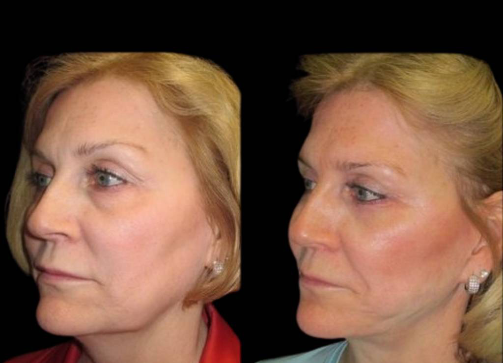 53-year-old-female-facelift-before-and-after-three-quarter-view.jpg