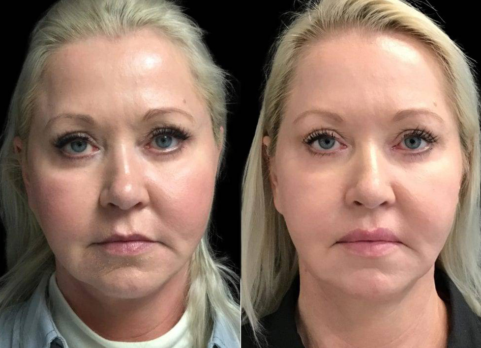 53-year-old-female-lip-lift-before-and-after-front-view-.jpg