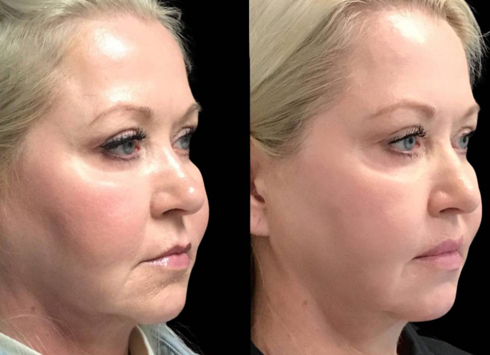 53-year-old-female-lip-lift-before-and-after-three-quarter-view-.jpg