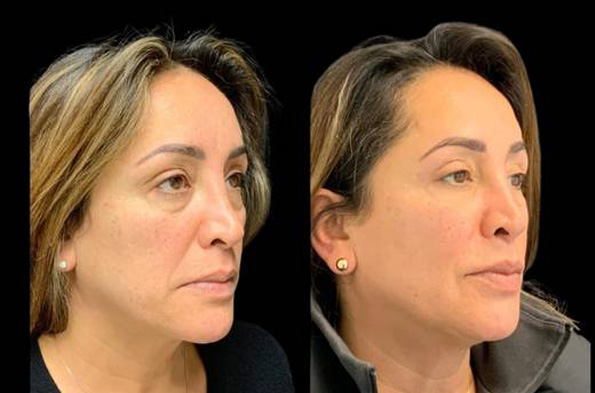 53-year-old-female-upper-and-lower-eyelid-lift-before-and-after-three-quarter-view-30311.jpg