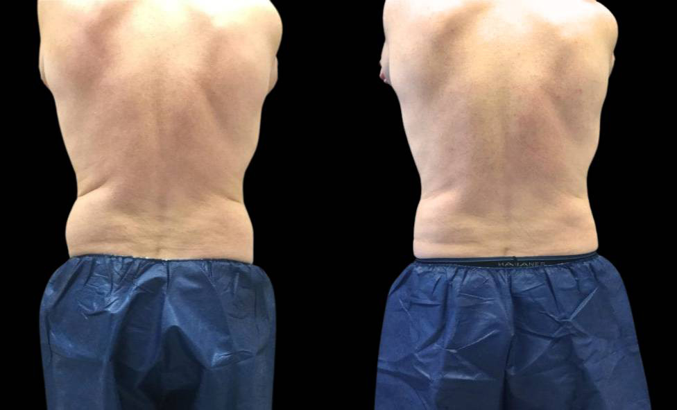 53-year-old-male-coolsculpting-before-and-after-back-view.jpg