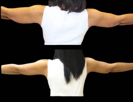 This is a 54-year-old female that has had an arm lift done showing the before and after's side-by-side