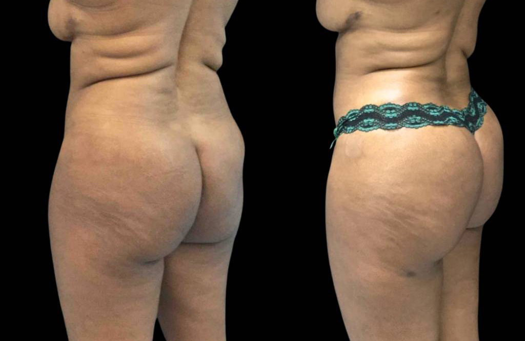 This is a 54-year-old female that has had a brazilian butt lift showing the before and after's side-by-side
