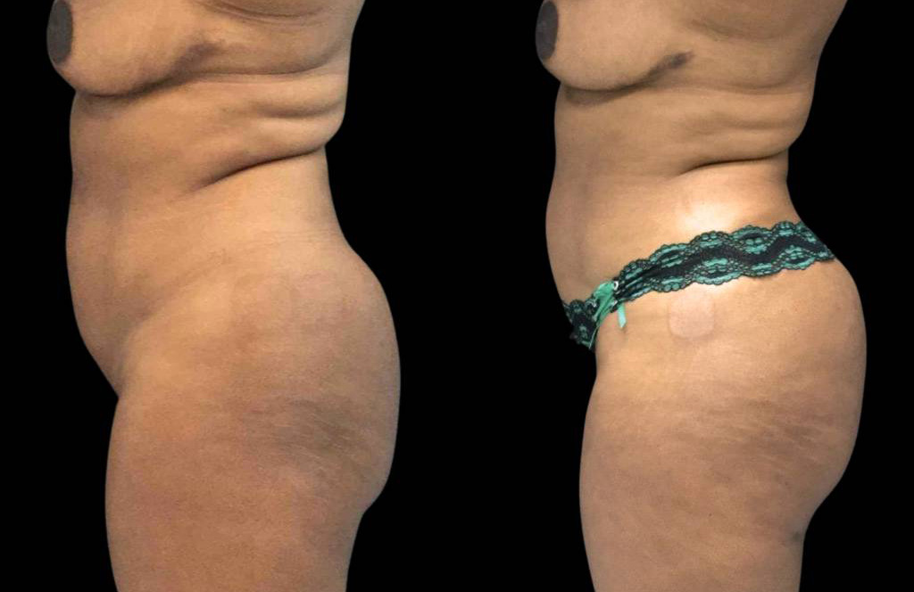 This is a 54-year-old female that has had a brazilian butt lift showing the before and after's side-by-side