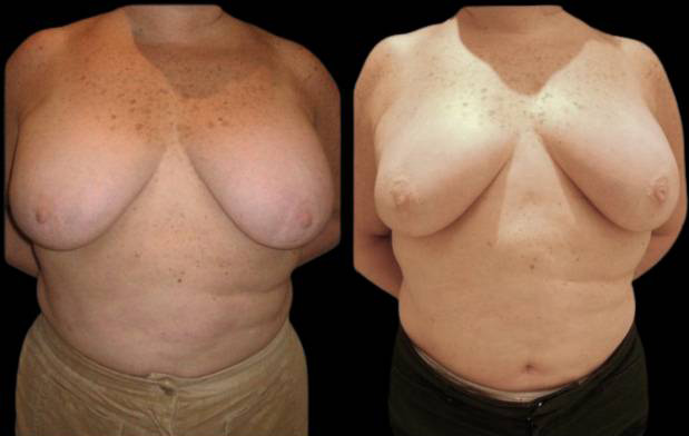 54-year-old-female-breast-reduction-by-liposuction-before-and-after-front-view.jpg