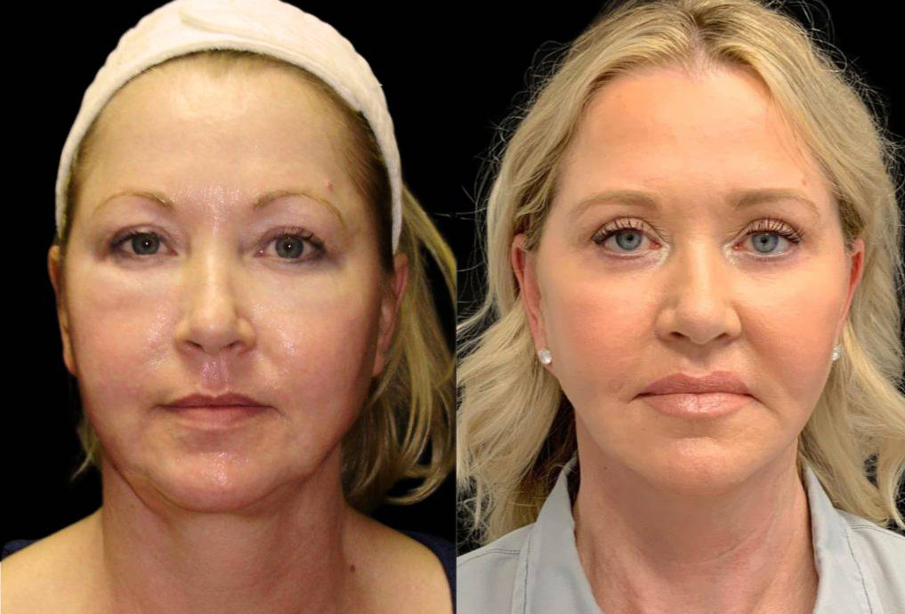 54-year-old-female-fat-grafting-before-and-after-front-view-5451.jpg