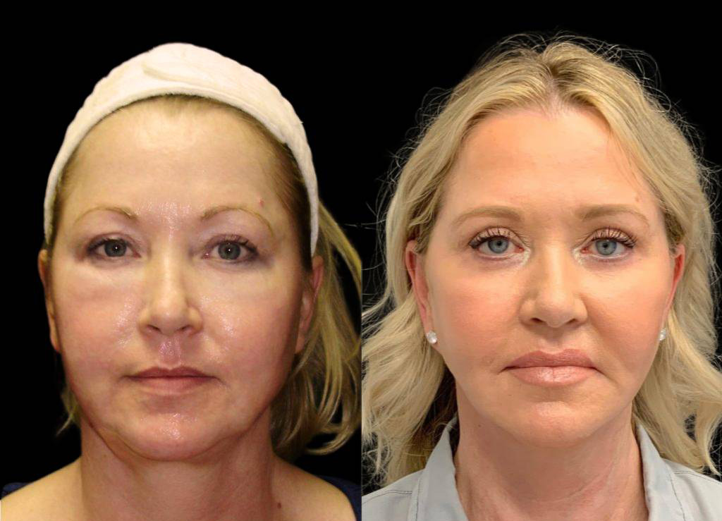 54-year-old-female-fat-grafting-before-and-after-front-view-5451.jpg