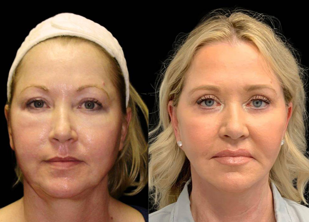 54-year-old-female-fat-grafting-before-and-after-front-view-5451.jpg