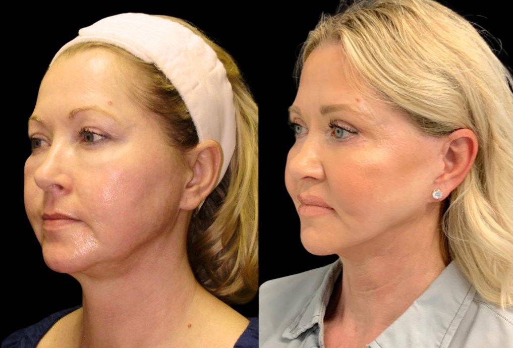54-year-old-female-fat-grafting-before-and-after-three-quarters-view.jpg