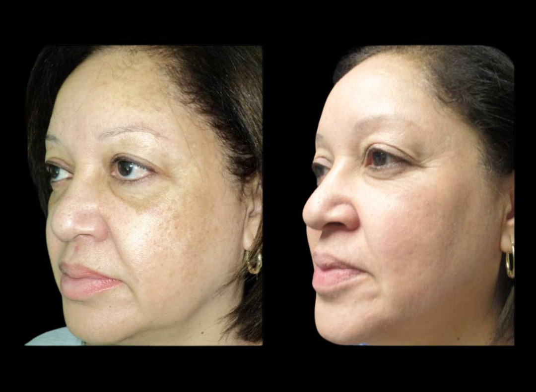 54-year-old-female-melanage-peel-before-and-after-1.jpg