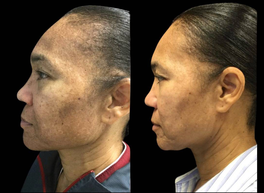 54-year-old-female-melanage-peel-before-and-after-4.jpg