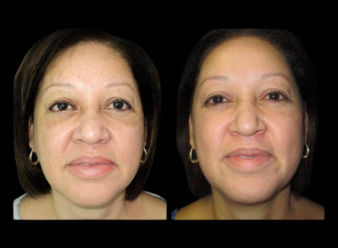 54-year-old-female-melanage-peel-before-and-after.jpg