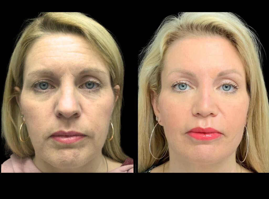 54-year-old-female-model-lift-before-and-after-front-view-26558.jpg