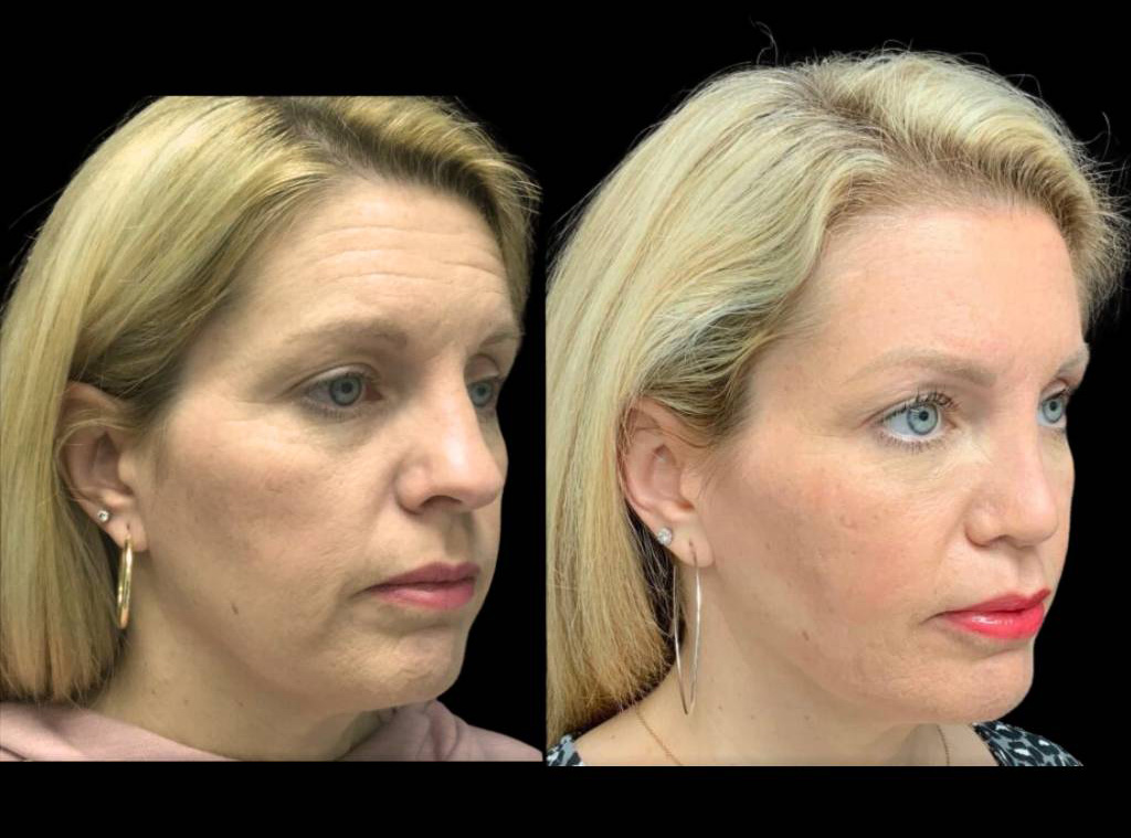 54-year-old-female-model-lift-before-and-after-side-view.jpg