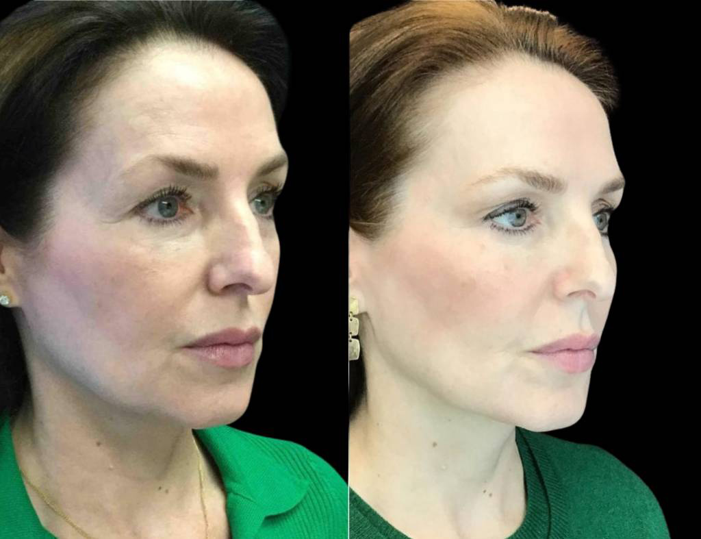 54-year-old-female-model-lift-before-and-after-three-quarter-view.jpg