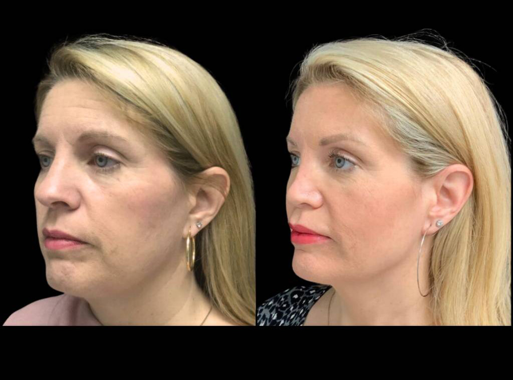 54-year-old-female-model-lift-before-and-after-three-quarter-view-2.jpg
