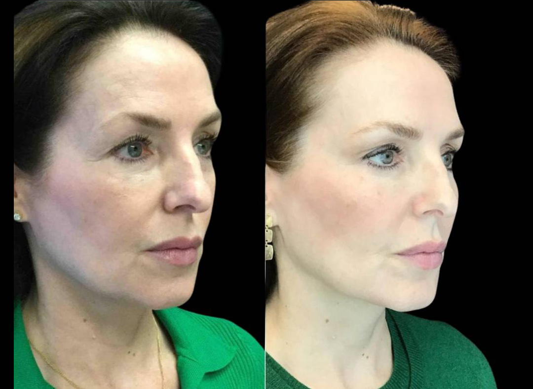 54-year-old-female-model-lift-before-and-after-three-quarter-view.jpg