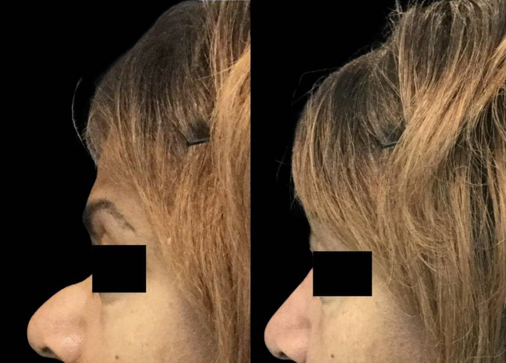 54-year-old-female-non-surgical-rhinoplasty-side-view.jpg