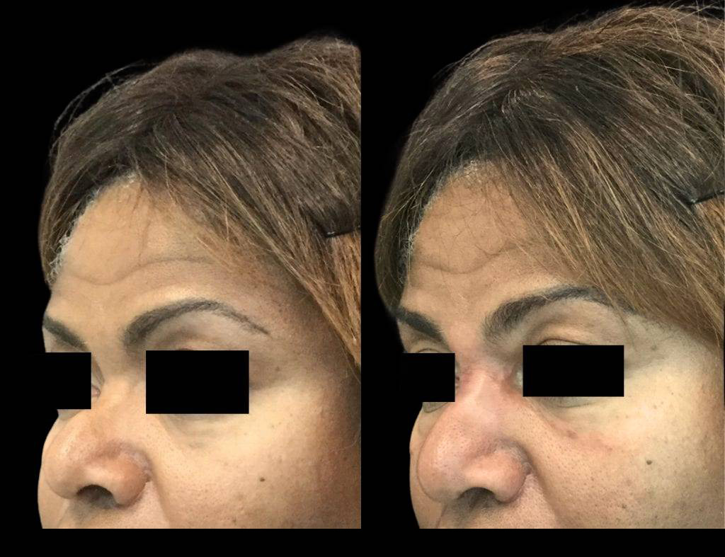 54-year-old-female-non-surgical-rhinoplasty-three-quarters-view.jpg