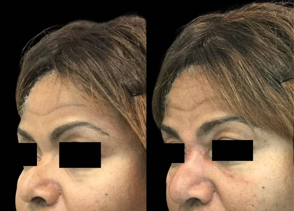 54-year-old-female-non-surgical-rhinoplasty-three-quarters-view.jpg
