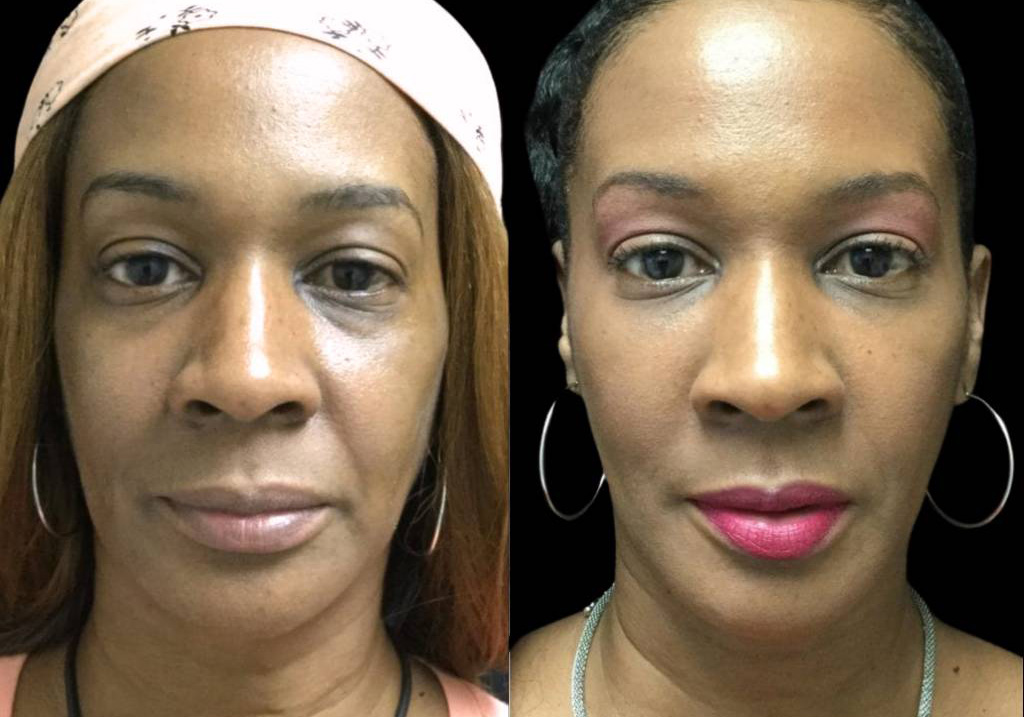 54-year-old-female-restylane-before-and-after-front-view-25738.jpg