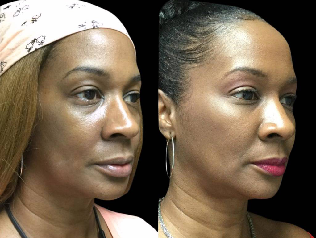 54-year-old-female-restylane-lift-before-and-after-three-quarter-view.jpg